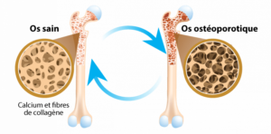 la vitamine D renforce la densité osseuse